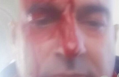 (FOTO) Vlorë/ Dhunohet barbarisht pronari i një kompanie autobusësh