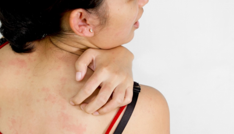 Rreziqet për lëkurën gjatë Verës