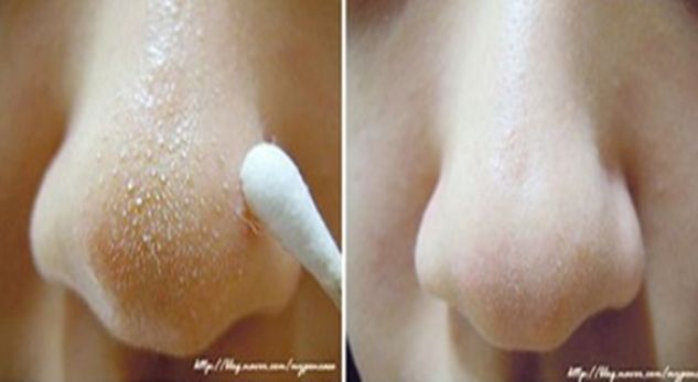 VIDEO/ Sekreti indian për heqjen e pikave të zeza në hundë