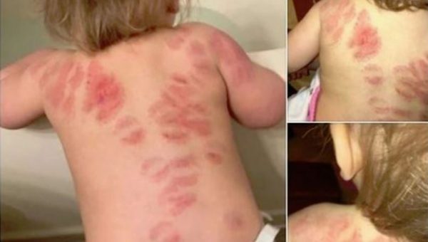 FOTO/ Kthehet me kafshime nga çerdhja, nëna tmerrohet me gjendjen e së bijës