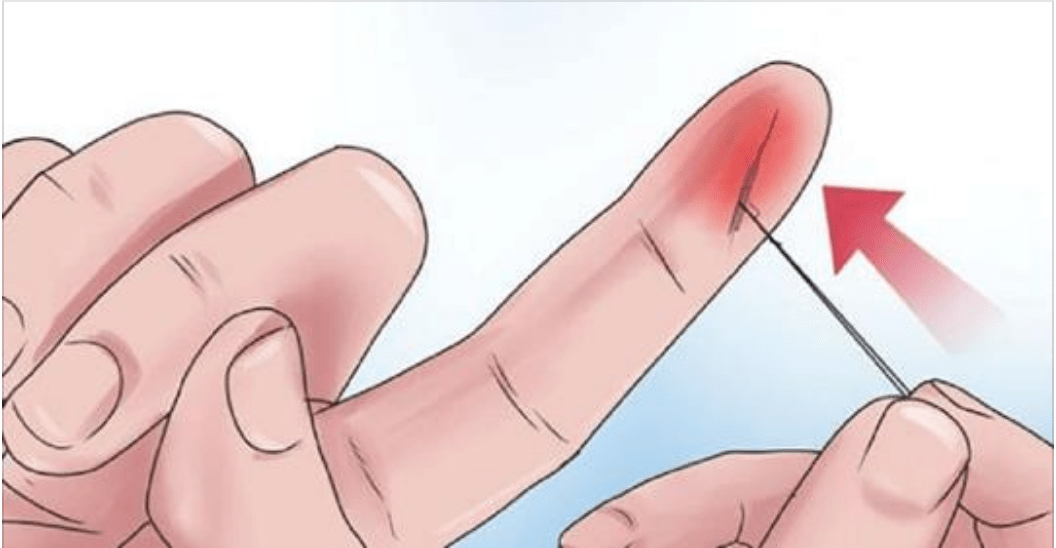 Bllokim të arterieve? Një gjilpërë mund t’ju shpëtojë jetën