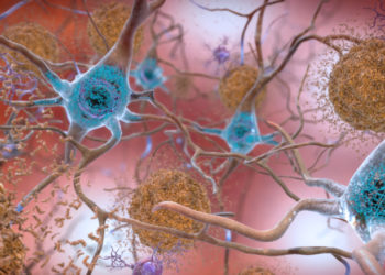 Studimi/ Pse gratë janë më të rrezikuara nga Alzheimeri?