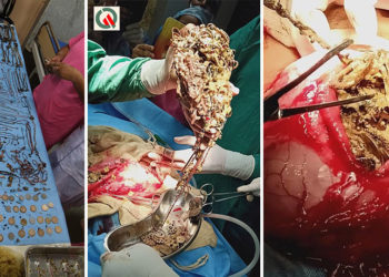 VIDEO/ E pabesueshme, doktorët i zbulojnë në stomak 1.6 kg bizhu me vlerë 53 mijë paund