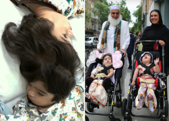 FOTO/ E rrallë, binjaket me kafka të ngjitura, ndahen pas 50 orë në sallën e operimit