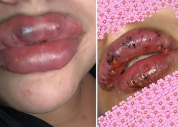 Vajza bëni kujdes kur të mendoni për të fryrë buzët, mund të përfundoni kështu