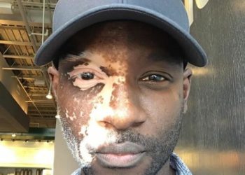 Mutacione gjenetike te njerëzit që i shihni rrallë