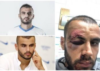 FOTO/ Skandali, futbollisti shqiptar masakrohet në Kroaci