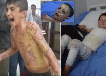 VIDEO+18/ “Babi ndalo djegien të lutem”, Pamjet e tmerrshme tregojnë fëmijët e djegur në Siri