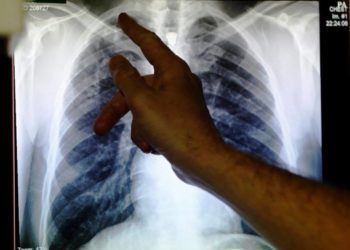 Shtohen rastet me tuberkuloz në Shqipëri, OBSH: Shumica meshkuj