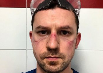 Fotoja e këtij mjeku italian me plagë në fytyrë nga maska po bën xhiron e rrjetit: Ja apeli i tij!