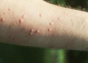 Nëse keni këtë shenjë në lëkurë, mund të jeni me koronavirus
