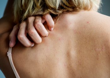 A shfaq virusi shenja në lëkurë? Flet dermatologia
