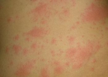 Skuqje në këmbë dhe lëkurë, shenjat e pazakonta që shfaqen tek pacientët me COVID-19 po habisin studiuesit