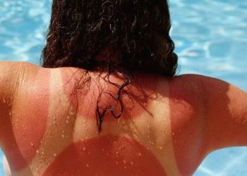 Tre produkte që duhet të përdorni nëse jeni djegur nga dielli, jo më kos…
