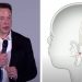 Elon Musk prezanton çipin sa një monedhë: Instalohet në tru dhe mund të shërojë verbërinë, paralizën apo parkinsonin