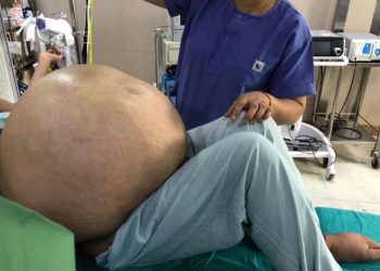 Mbi 180 minuta operacion, hiqet me sukses tumori më i madh ovarian