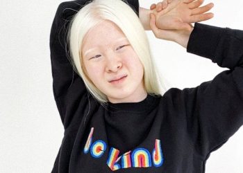 U braktis nga prindërit, modelja albine nga më të preferuarat në botë (FOTO)