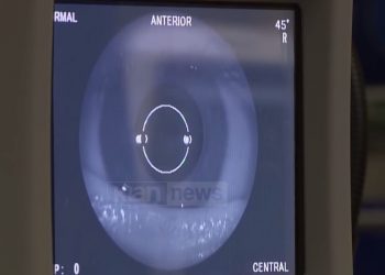 Covid prek edhe sytë, specialistët: Kemi ndeshur paraliza faciale, kujdes dhe nga alergjitë e syrit