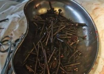 Ndaloi së dehuri me alkol por hante gozhdë e bulona, iu gjetën 1 kg sende metalike në stomak!