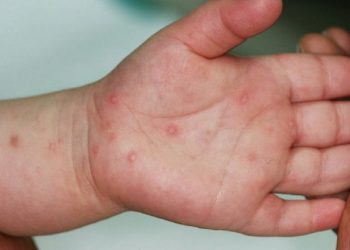 Sëmundja prej kohësh në Shqipëri/ Mjeku: Nuk ka mjekim, mbajini fëmijët në shtëpi