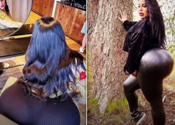 5 operacione për ngritjen e të pasmeve/ Tani 29 -vjeçarja ka një tjetër problem, s’mund të ulet në karrige