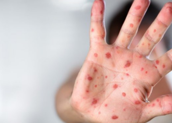 Lija e majmunëve/ A jemi pranë një emergjence shëndetësore globale?