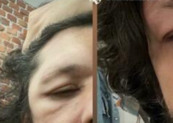 FOTO: Anulon disa koncerte, çfarë po ndodh me Ermal Metën? Ënjtje në fytyrë e kokë, këngëtari probleme me shëndetin