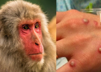 Alarmi: Konfirmohet viktima e parë në Europë nga lija e majmunit