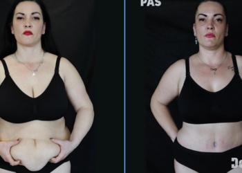 “Dukesha e shëmtuar”/ Për 10 vite me radhë i fshehu defektin burrit, bën ndërhyrjen e dëshiruar te Doktor Plastik