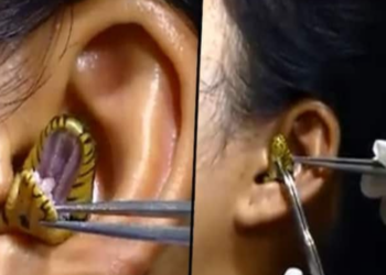 Gjarpri i ngec brenda veshit, video e gruas bëhet virale