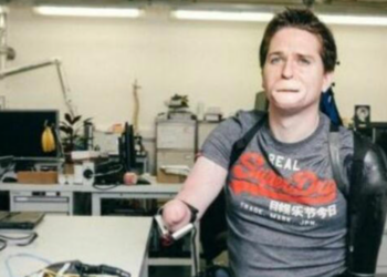 Mendoi se kishte grip, por 42-vjeçari ngeli pa gjymtyrë dhe me fytyrë të shpërfytyruar nga bakteri vrasës