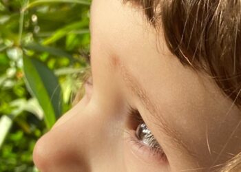 Sëmundja që po përhapet me shpejtësi në Shqipëri! Mjekja: Mos e neglizhoni, nëse nuk e trajtoni lë pasoja të rënda