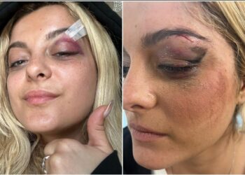 Incidenti/ Me sy të nxirë dhe të ënjtur, dalin fotot e Bebe Rexhës pasi u godit me telefon në fytyrë gjatë koncertit