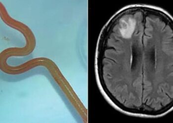 Gjendet krimbi 8 cm në trurin e një gruaje / Mjekët: Kurrë më parë një rast i tillë tek njerëzit, vetëm tek gjarpërinjtë