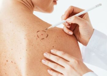 Shpresë për kancerin e lëkurës, testohet vaksina për trajtimin e melanomës