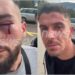 VIDEO/ Me plagë në sy dhe hematoma, ja kush janë të rinjtë e dhunuar në Mal të Zi nga një grup serbësh