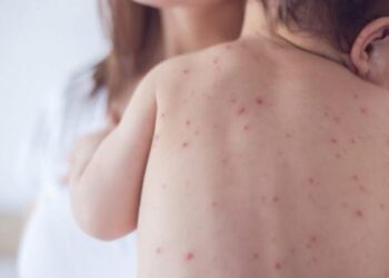Shkon në 17 numri i të prekurve nga fruthi, mjekët: Bëni vaksinën