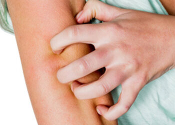 Shqipëria në alarm nga zgjebja? Dermatologia: S’ka vend për panik, sëmundje që kurohet lehtësisht