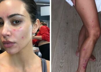 Kim Kardashian flet për sëmundjen që po i shkakton dhimbje të mëdha: S’e di çfarë po ndodh