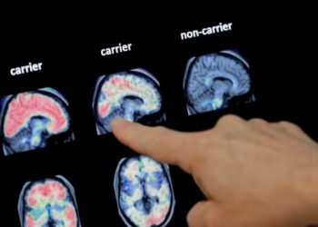 Zbulime të reja, testi i gjakut mund të përcaktojë diagnozën me Alcajmer