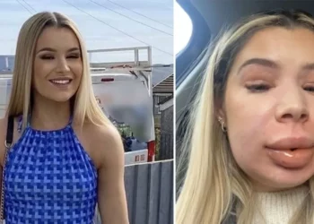 Shkoi për të fryrë buzët tek estetistja, 24-vjeçarja përfundon me fytyrë si tullumbace