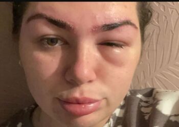 Shkoi për të rregulluar vetullat, 28-vjeçarja rrezikon të humbasë shikimin, denoncon sallonin estetik dhe publikon fotot “horror”