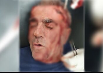 Emri/ U godit me zinxhir në kokë nga një person i maskuar, efektivi i burgut të Fierit i plagosur në spital