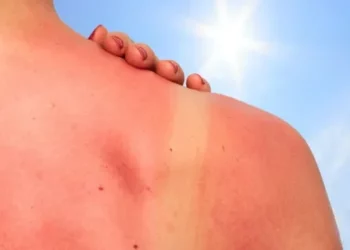 Këto janë 5 mënyra si të trajtoni djegien nga dielli në kushte shtëpie