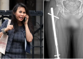 Pretendon se kirurgia plastike e la me një këmbë më të gjatë se tjetra, bankierja padit mjekun, kërkon shifrën e majme