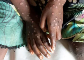 Lija e majmunit, BBC: E rrezikshme! Kush udhëton duhet të vaksinohet