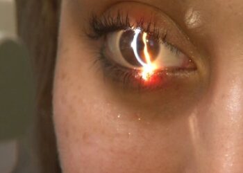 Operacion me lazer në sy? Flet okulisti Boriçi: Ja kur mund të kryejmë ndërhyrje!