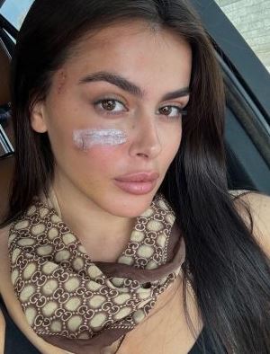 FOTO/ Ajo që ndodhi mes tyre “theu rrjetin”, si paraqitet situata e Klea Prengës pas dhunës nga motrat Berisha