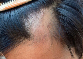 Problemet me tiroiden te të rinjtë, ja sinjalet që jep trupi