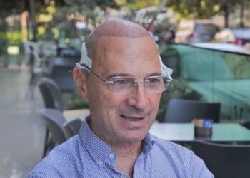 Të huajt në Shqipëri për ‘turizëm’ mjekësor, 2 miqtë italianë kryejnë transplant flokësh: Çmimet më të lira në Tiranë se sa në Itali